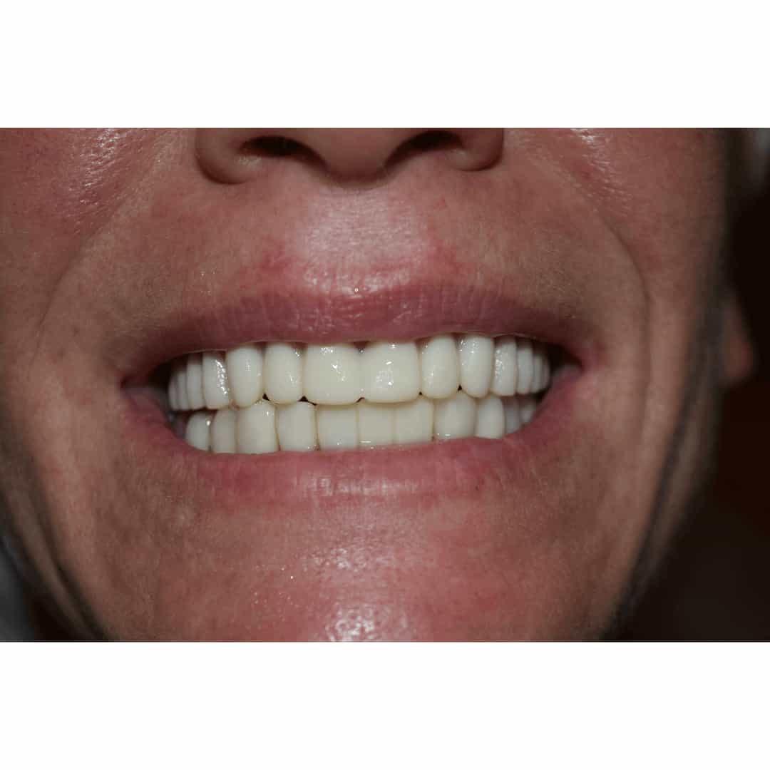Easy Denture on satisfied user